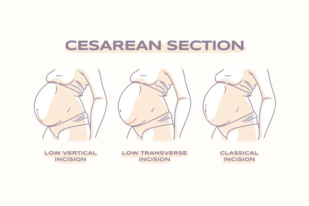 Understanding Cesarean Section: What to Expect and How to Prepare