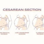 Understanding Cesarean Section: What to Expect and How to Prepare